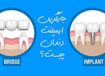 بهترین جایگزین ایمپلنت دندان چیست؟