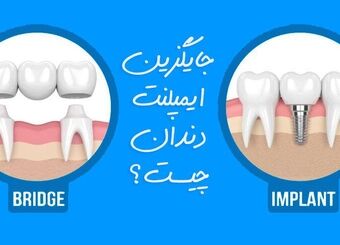 بهترین جایگزین ایمپلنت دندان چیست؟