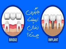 بهترین جایگزین ایمپلنت دندان چیست؟